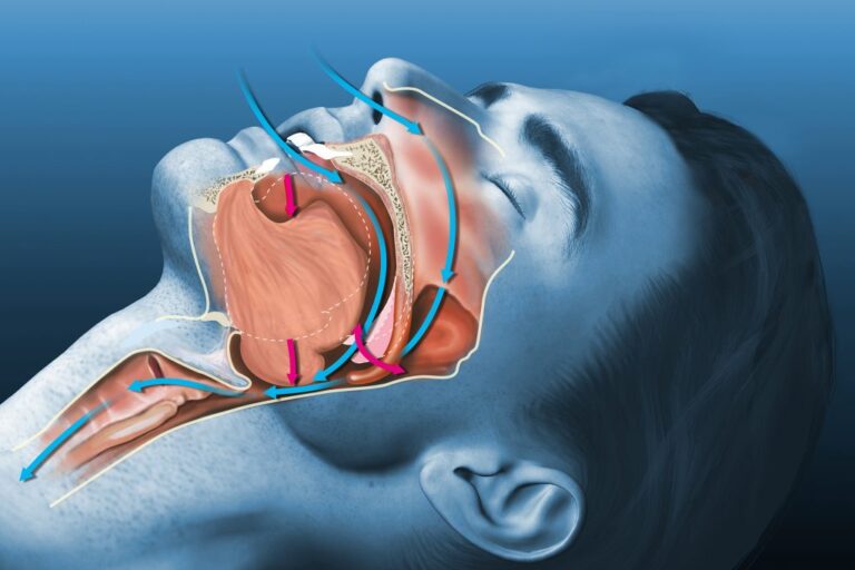 مشكلة إنقطاع التنفس أثناء النوم –  الدكتور راكان حداد